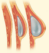 breast_reconstruction-6