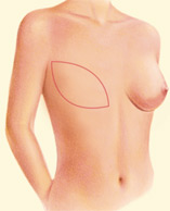 breast_reconstruction-5