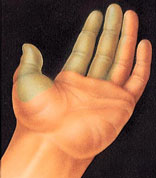 Hand Surgery | Hand Injuries | NJ