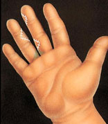 Hand Surgery | Hand Injuries | NJ