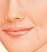 injectable_fillers-2