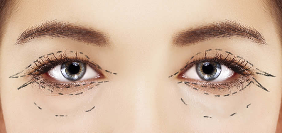 Eyelid surgery incision diagram