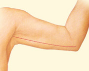 arm-lift-after-2