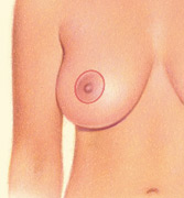 breastlift-periareolar-after