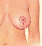 breastlift_horizontal-after