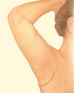 minimal-incision-arm-lift-after