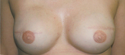 Patient # 52321 After Photo # 2