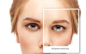 Blepharoplasty Little Silver, NJ